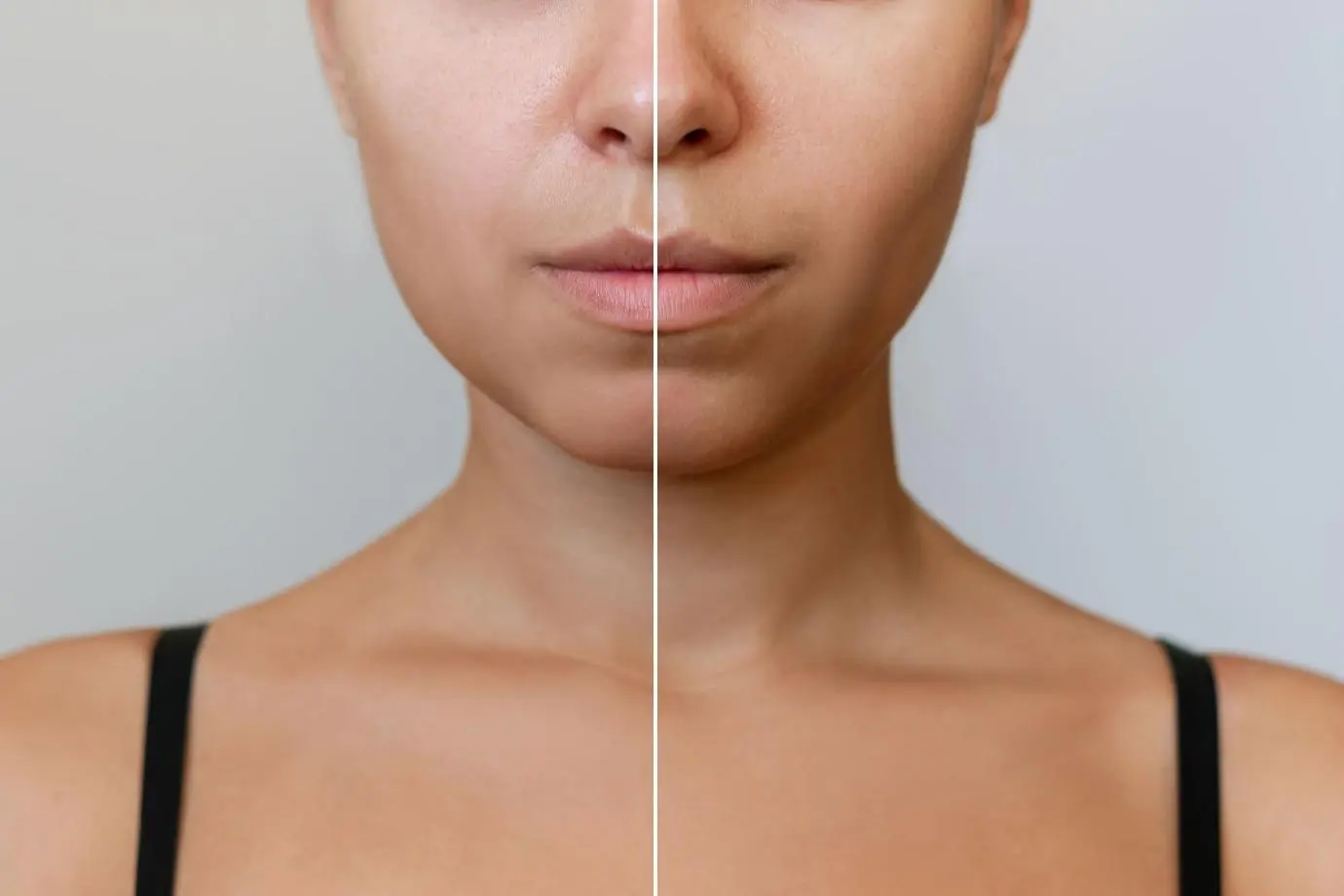 Buccal Fat Removal