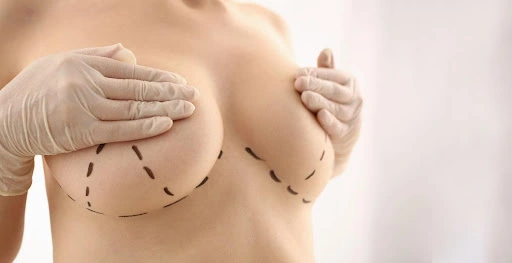 rekomendasi prosedur menghilangkan areola melebar
