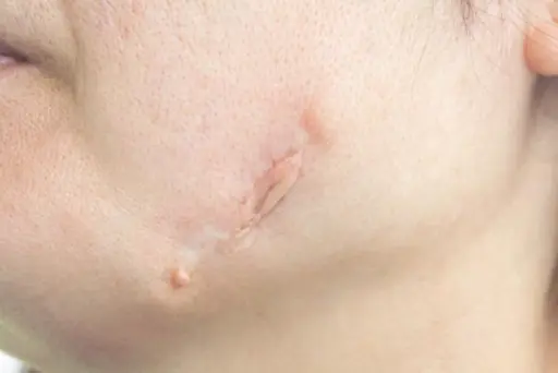 cara menghilangkan keloid di wajah