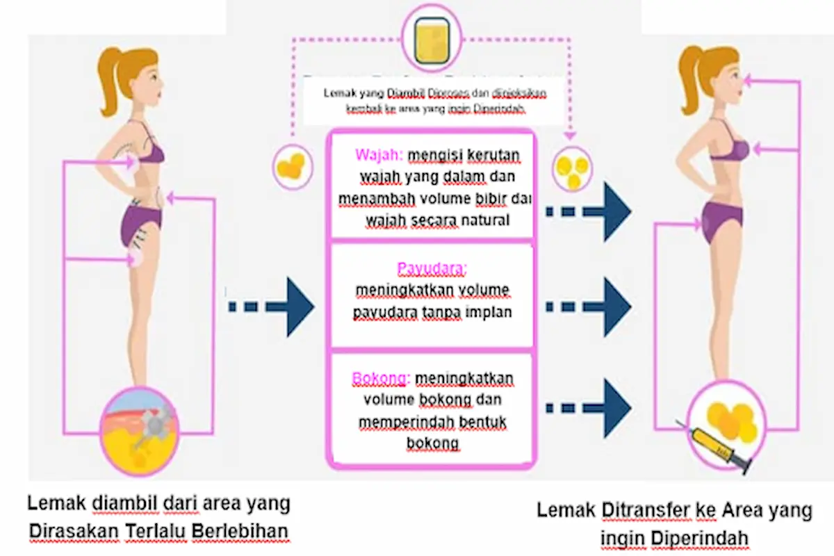 apa itu transfer lemak 1