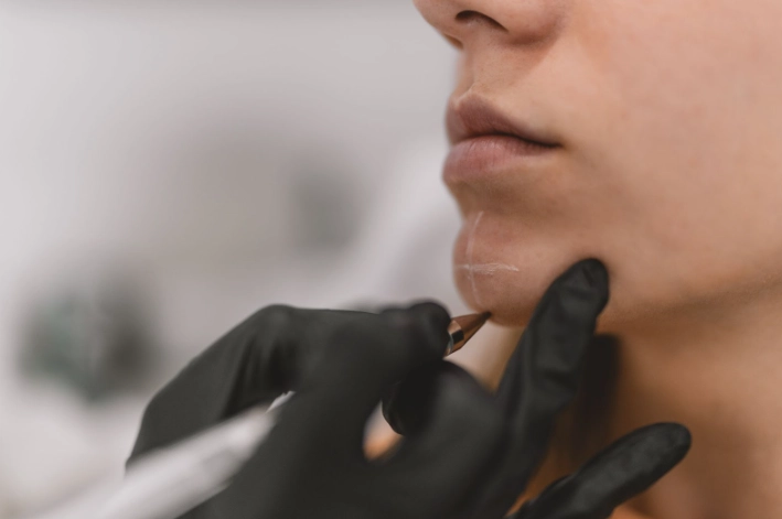 chin augmentation adalah