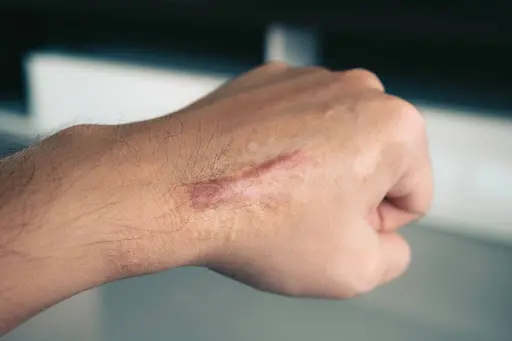 hypertrophic scar vs scar