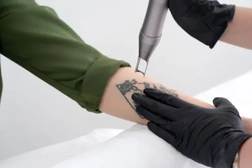 cara menghilangkan tato