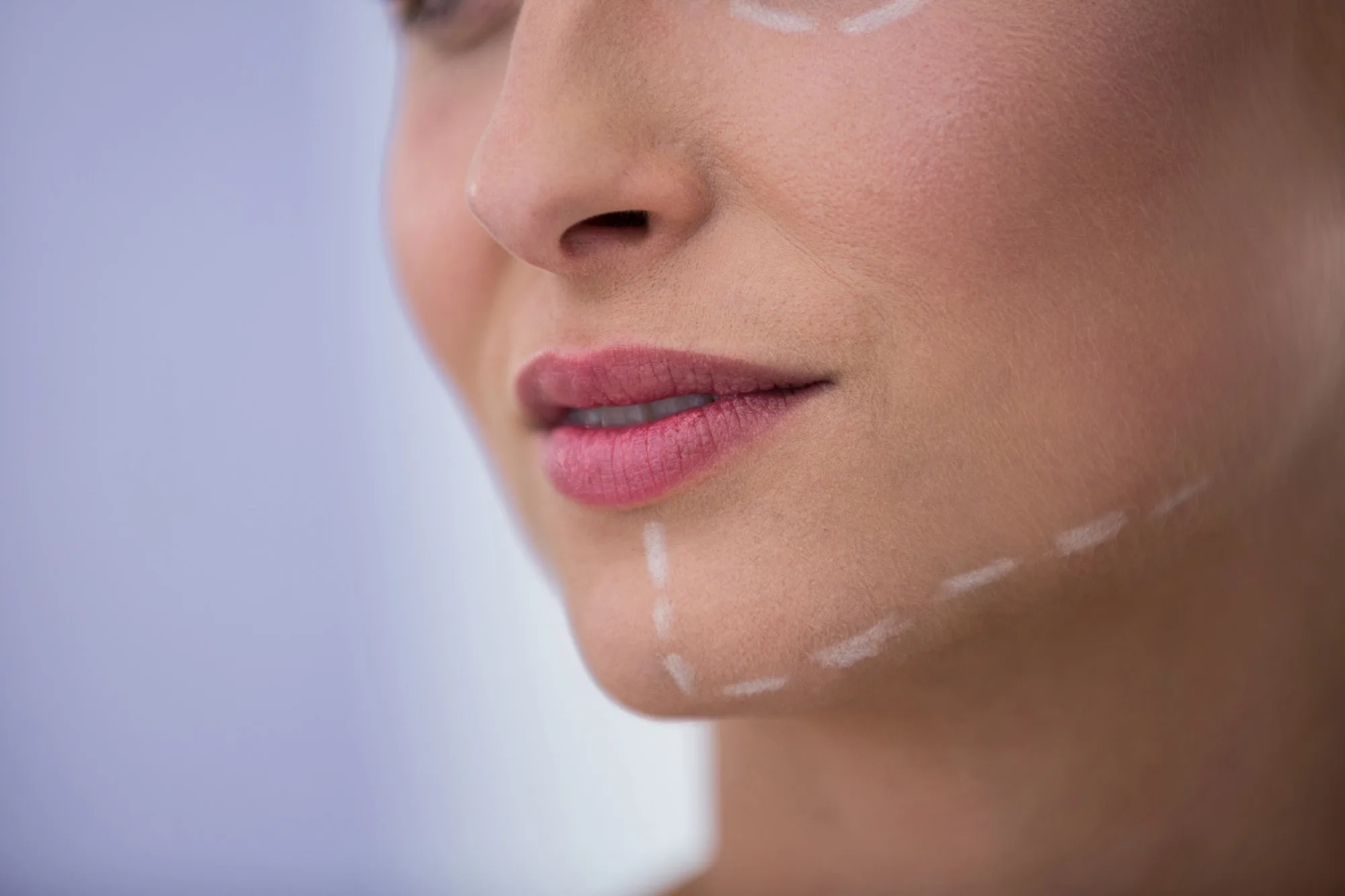 berapa lama hasil filler senyum terlihat