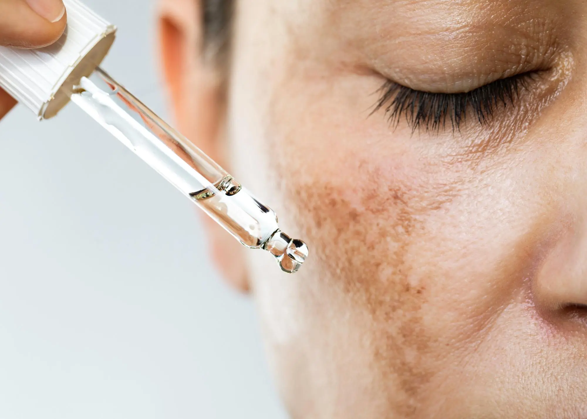 cara menghilangkan melasma