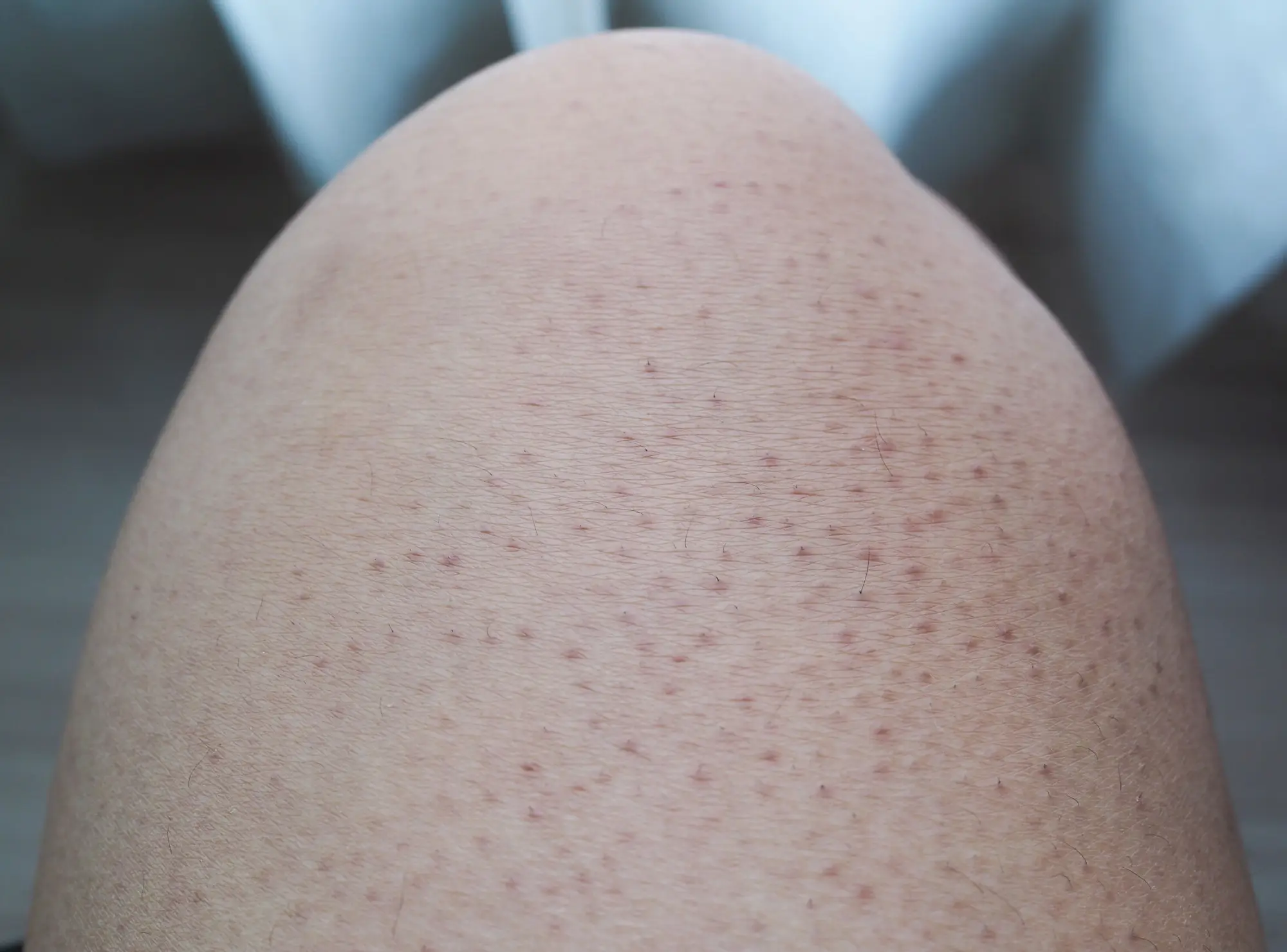 cara menghilangkan keratosis pilaris