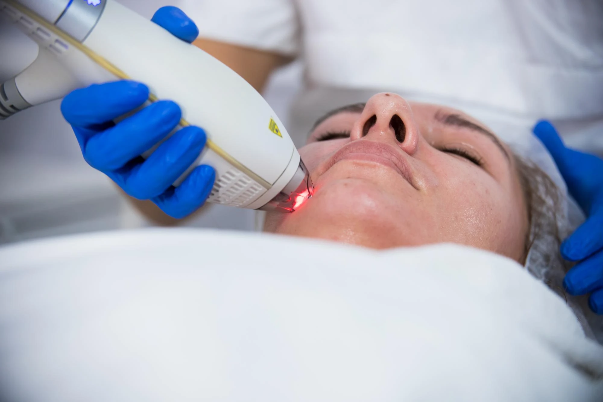 laser jerawat