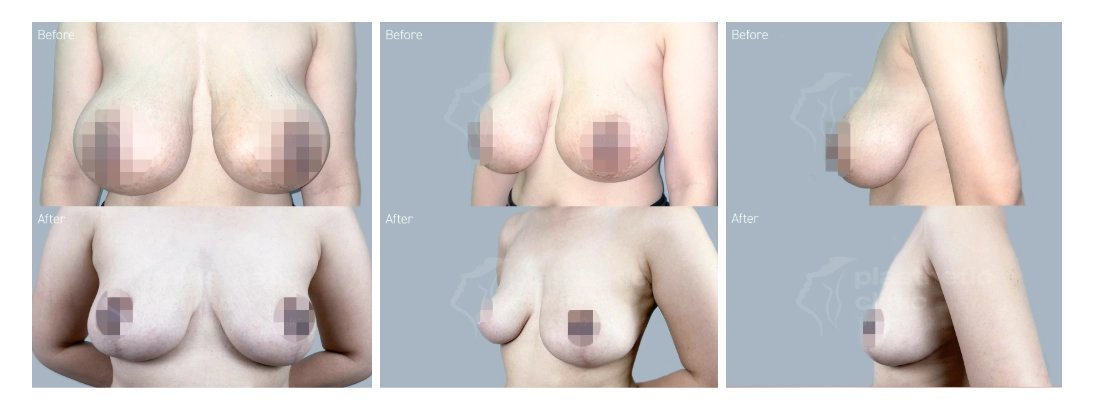 Before & After Tindakan Breast Reduction