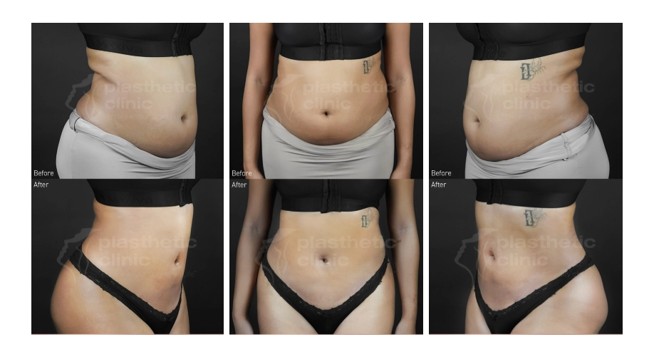 Before & After Tindakan Liposuction Perut