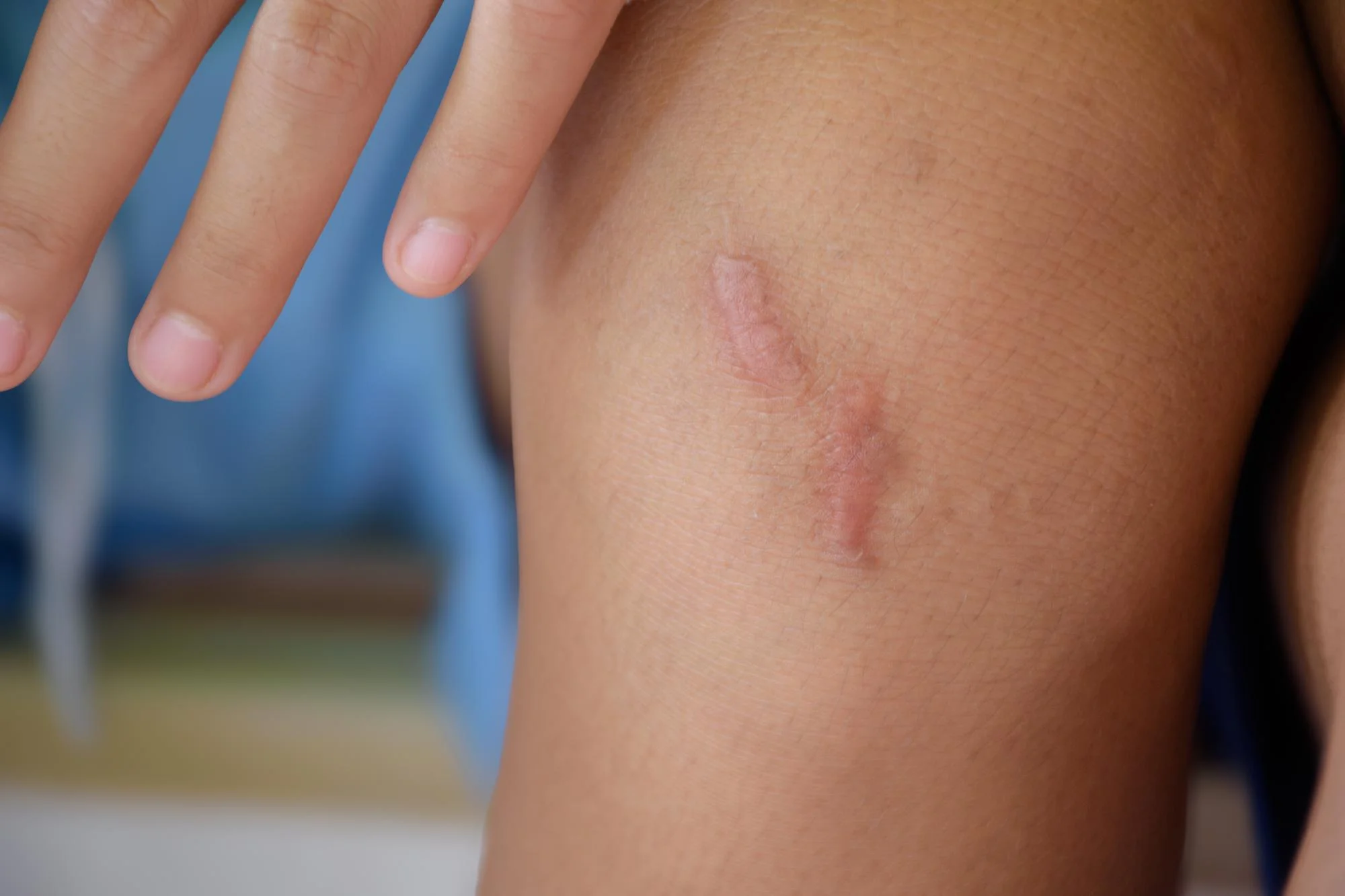 operasi keloid