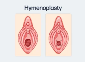 Before and After Tindakan Hymenoplasty