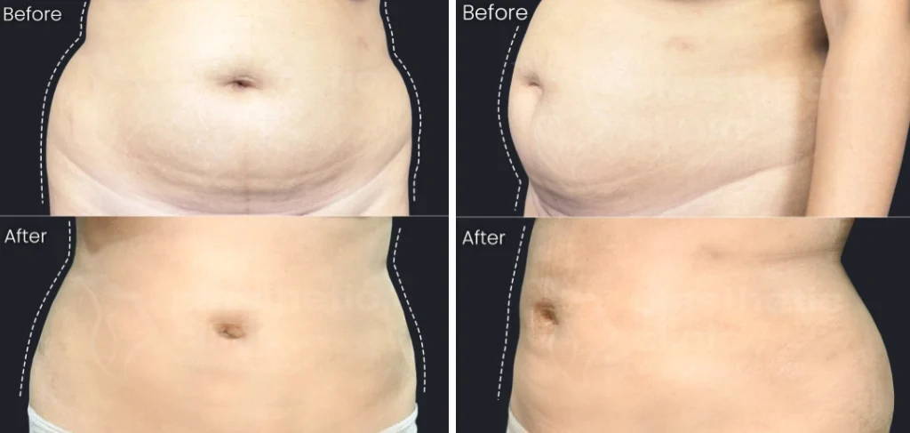 Before and After Tindakan Liposuction : Sedot Lemak Perut
