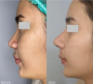 Before and After Tindakan Rhinoplasty Double Ear Cartilage