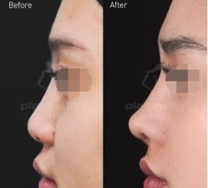 Before and After Tindakan Rhinoplasty Iga / Rib Cartilage