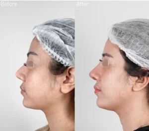 Before and After Tindakan Rhinoplasty Mix