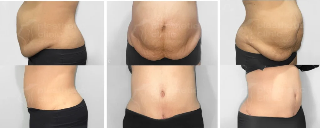 Before and After Tindakan Tummy Tuck