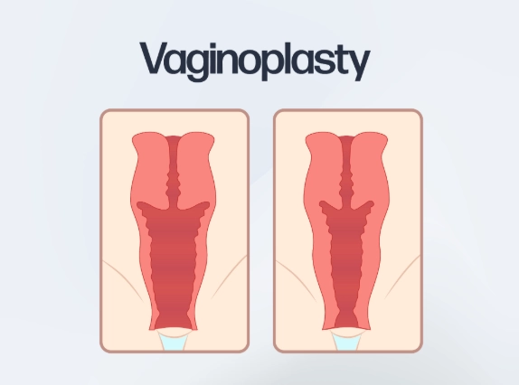 Before and After Tindakan Vaginoplasty