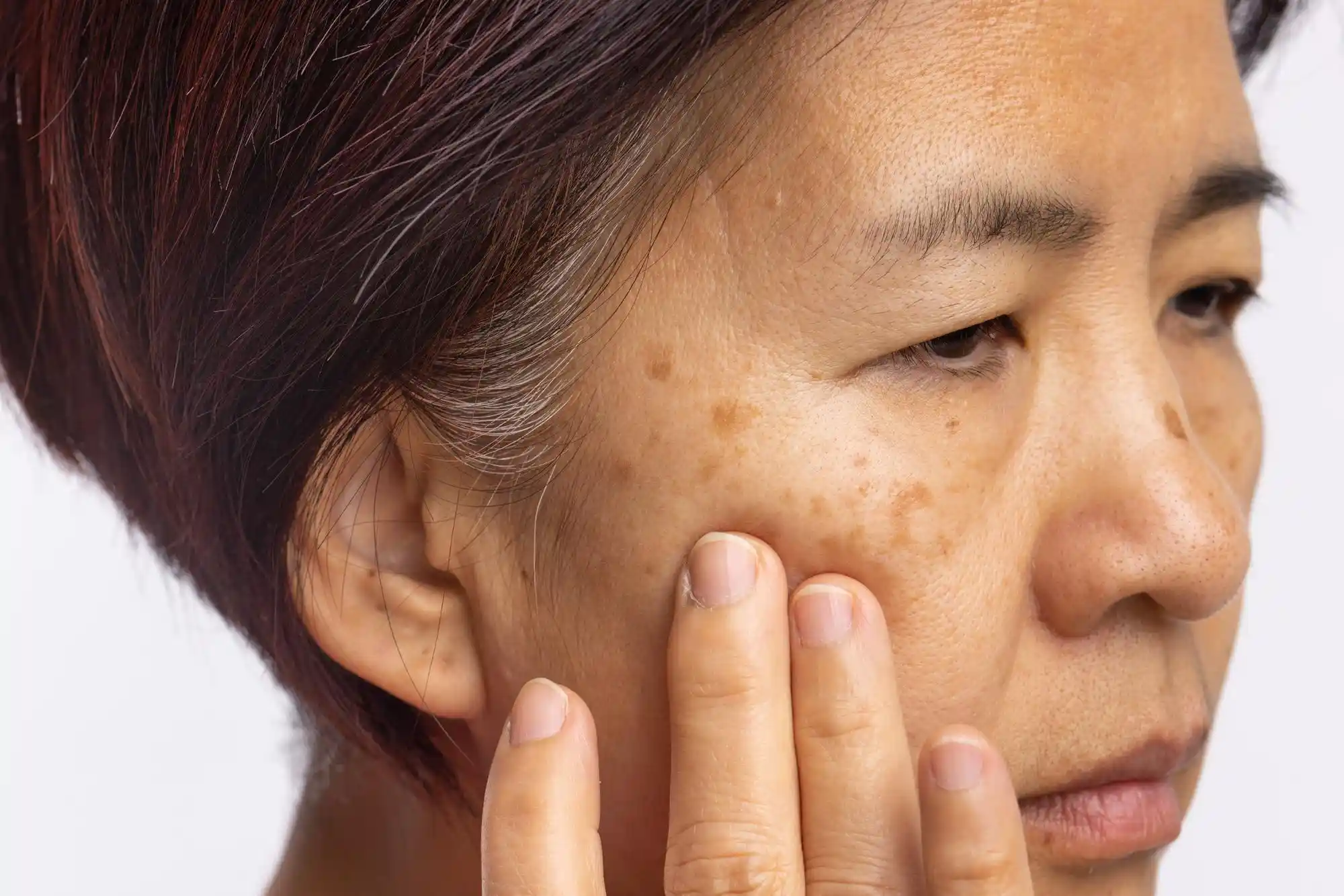 melasma pada wajah