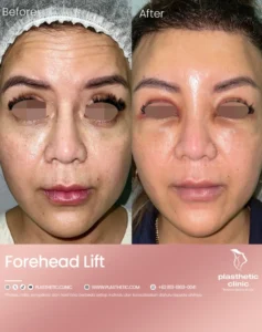 Before and After Tindakan