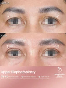 Before and After Tindakan