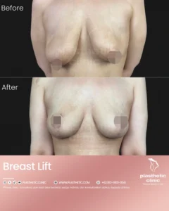 Before and After Tindakan Breast Lift