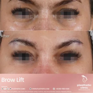Before and After Tindakan Brow Lift