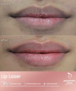 Before and After Tindakan Laser Pink Lip