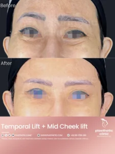 Before and After Tindakan Mid Cheek Lift