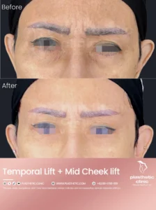 Before and After Tindakan Mid Cheek Lift