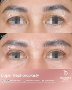 Before and After Tindakan Upper Blepharoplasty