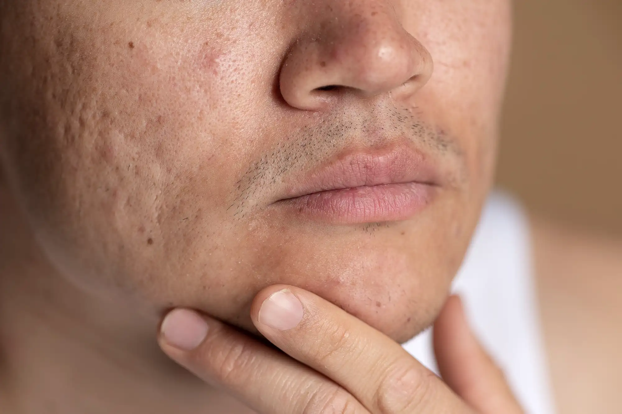 Atrophic Scar