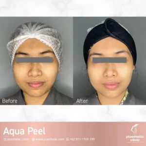 Before and After Peeling
