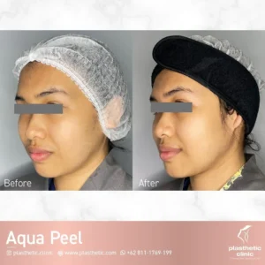 Before and After Peeling