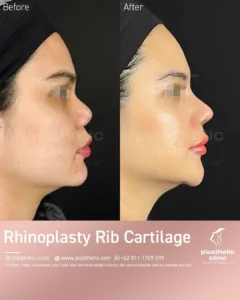 Before and After Rhinoplasty