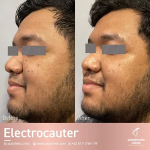 Before and After Tindakan Electrocauter