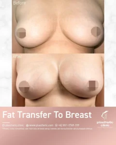 Before and After Tindakan Fat Transfer To Breast