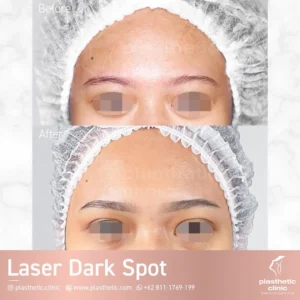 Before and After perawatan Laser Scar