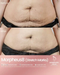 Before and After perawatan Morpheus8