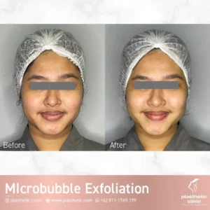 Before dan After Microbubble Exfoliation