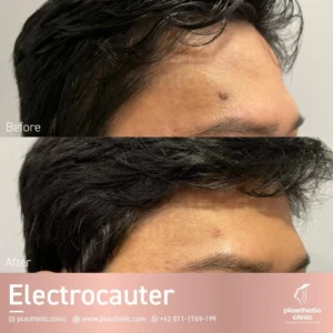 Before dan After Tindakan Electrocauter