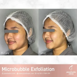 Microbubble Exfoliation