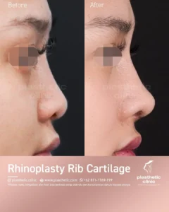 rhinoplasty rib cartilage